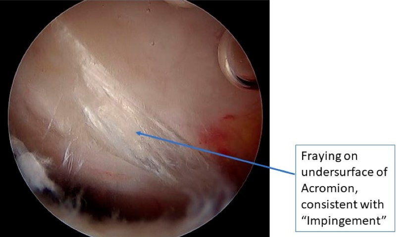 Impingement lesion labeled